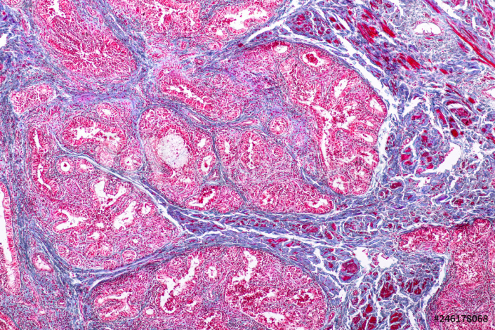 Combien De Temps Dure Une Ponction D'ascite La micro-biopsie mammaire - Radiologie Bordeaux